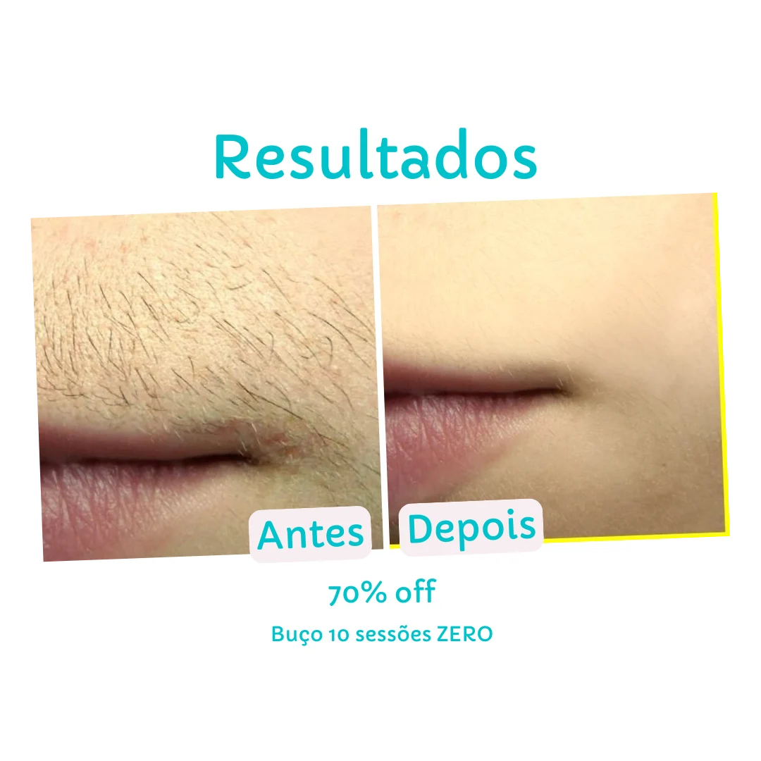Resultado Buço