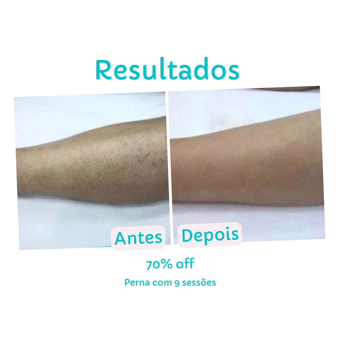 Resultado Perna